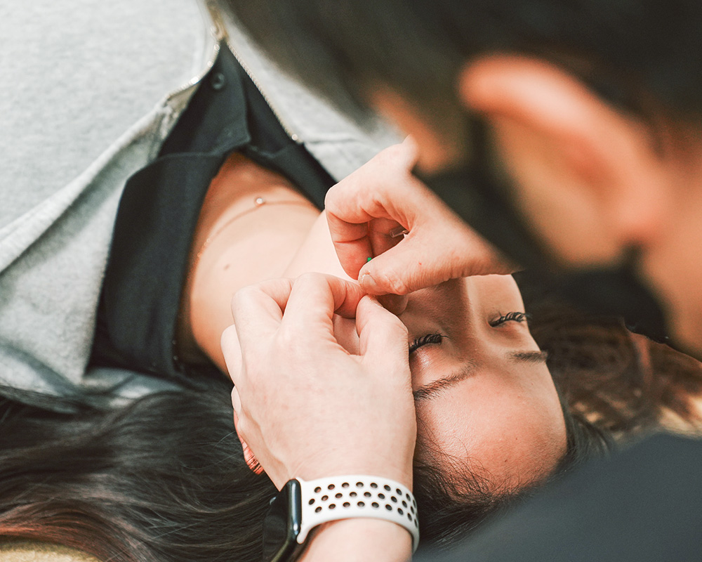 美容鍼のようす